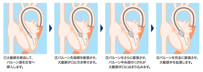 アプローチ手順