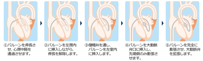 アプローチ手順